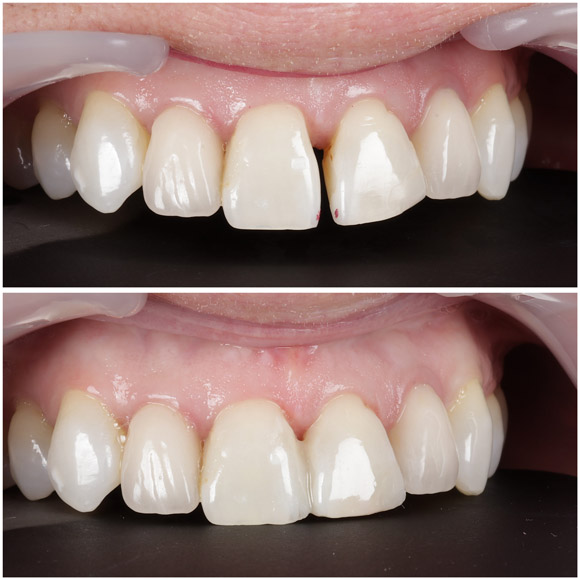 Veneers-5